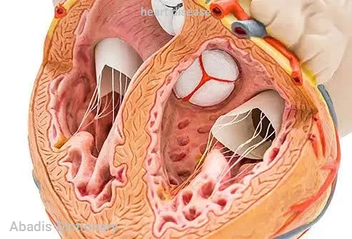 heart disease